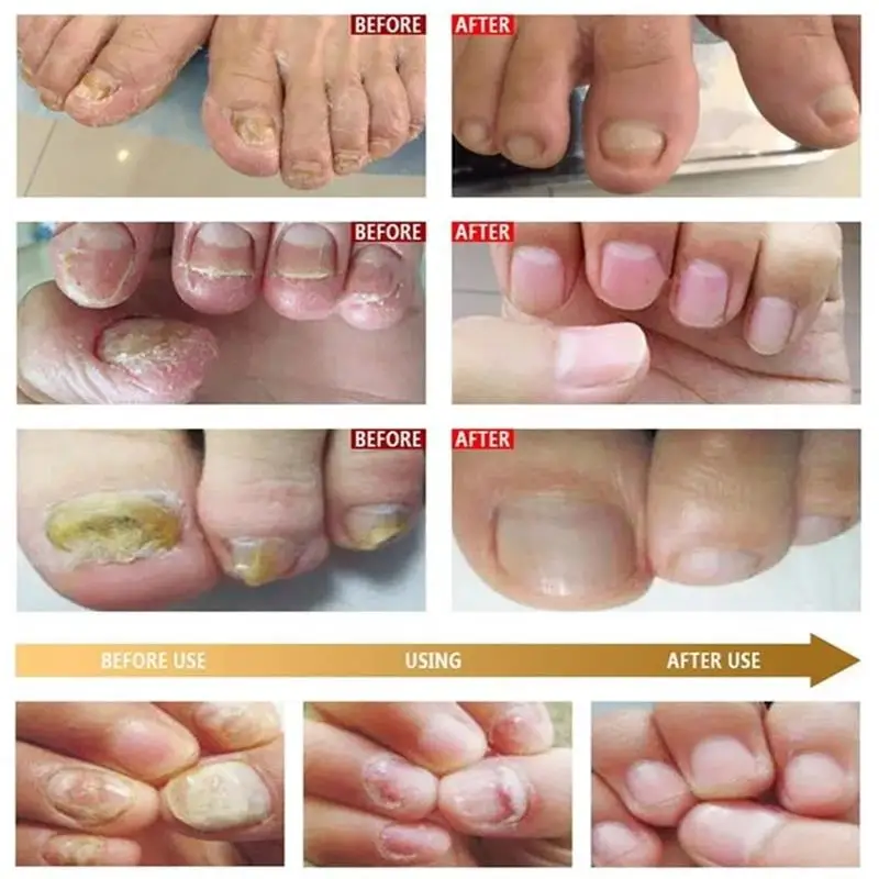 เซรั่มรักษาเชื้อราเล็บเท้า กำจัดเชื้อราที่เล็บนิ้วเท้า น้ำมันหอมระเหยป้องกันการติดเชื้อโรค โรคเล็บอักเสบ โรคเล็บอักเสบชนิดอักเสบบริเวณเล็บ บำรุงและฟื้นฟู