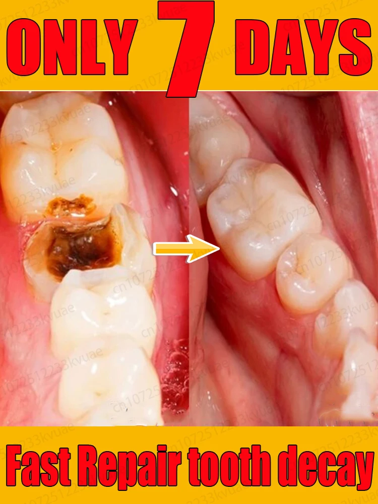 Use natural plant extracts to repair tooth decay, whiten teeth, and remove tooth decay