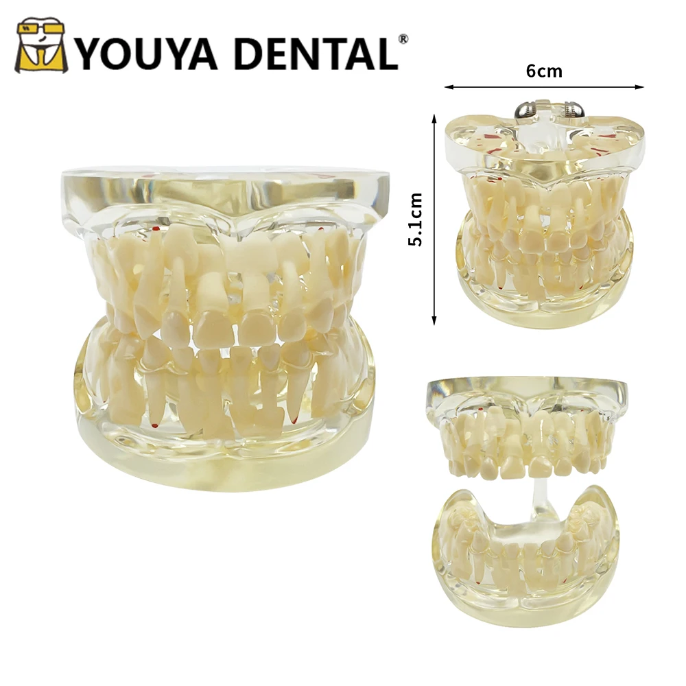 Dental Child Pathological Deciduous Teeth Model Baby Tooth Model for Dental Teaching Studying Doctor-patient Communication Tools