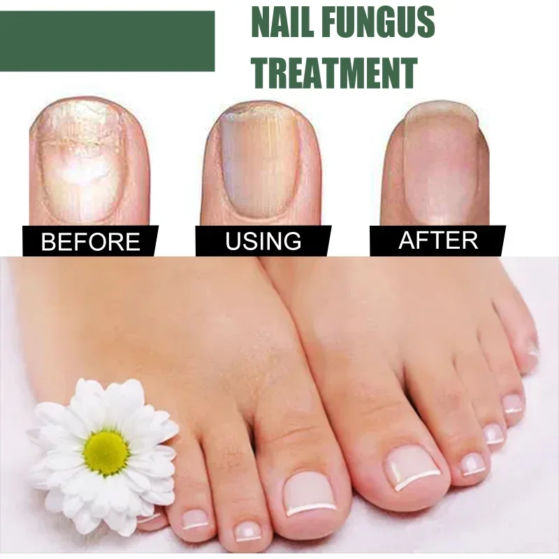 Sdotter New Nail Fungus Treatment Essence Oil Toe Nails fungal Removal Paronychia liquid Repair Gel Hand And Foot Anti-Infective