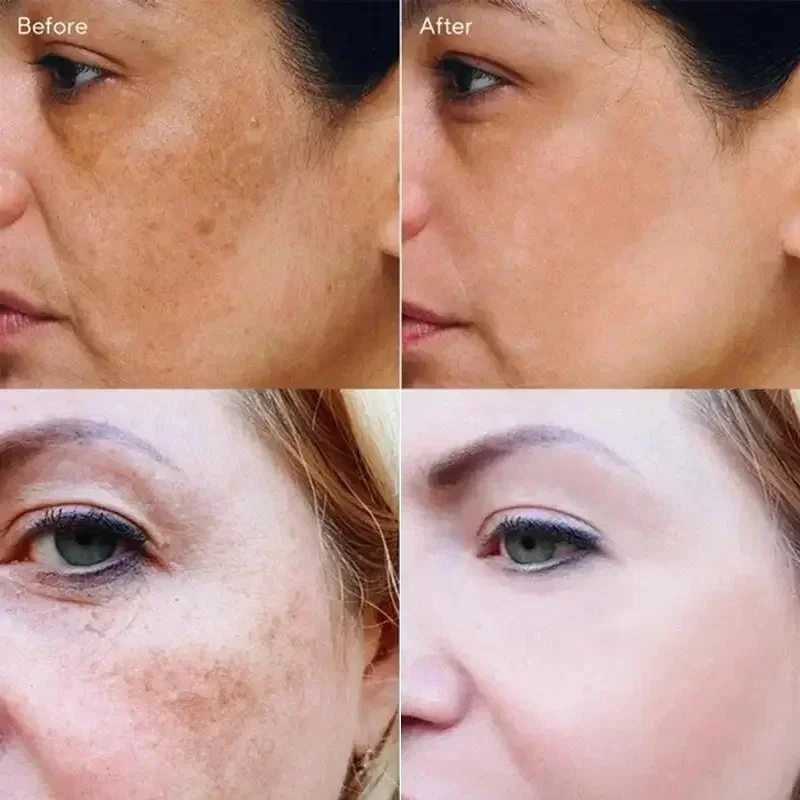 Vitamin C Whitening Freckles Facial Serum Remove Dark Spots Melasma Niacinamide Lighten Melanin Acne Scars Anti-aging Skin Care