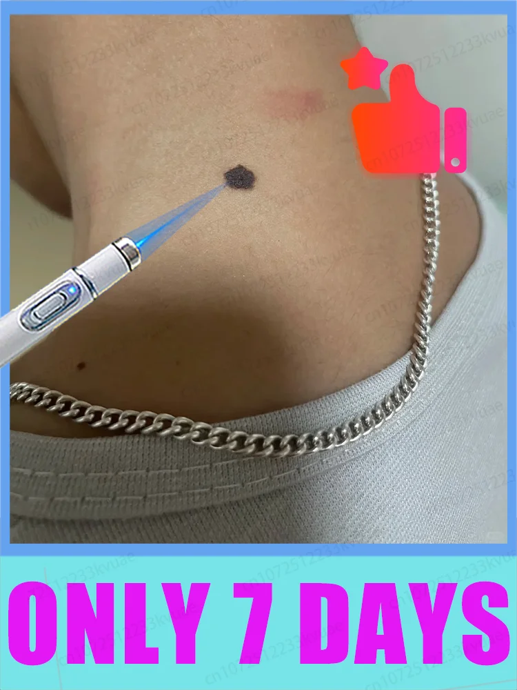 いぼ除去の神様、7日で結果が出ます