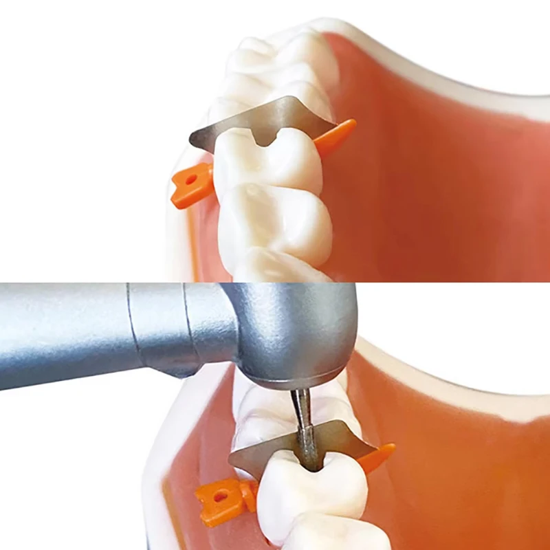 185 buah Kit Wedges Interdental, alat isi ulang berlian matriks pembagi pelindung Wedge celah gigi sekali pakai banyak gaya