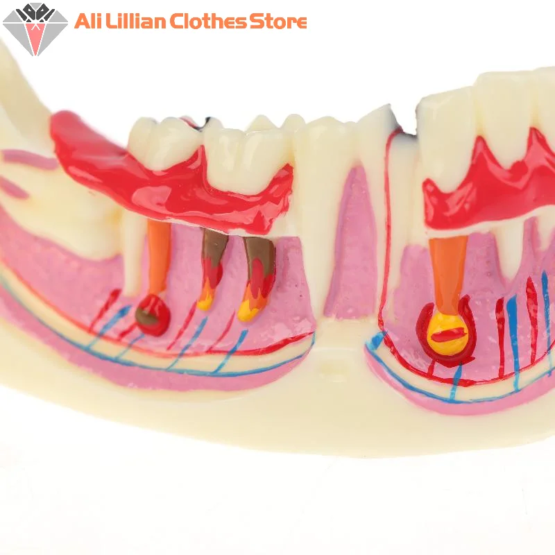 

Mandible Tissue Anatomical Model Dental Endodontic Treatment Model Anatomy Of Gums Dentist Teach Study Demonstration Teeth Model