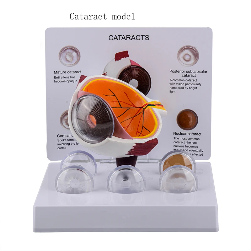 The model of the structure of the Cataract eyeball and the model of the Glaucoma eyeball