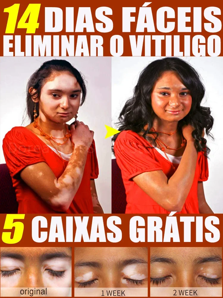 Vitiligo Treatment Cream Vitiligo Relief Spray Skin Treatment Lamp White Spot Removal Vitiligo Ointment Eliminate Vitiligo