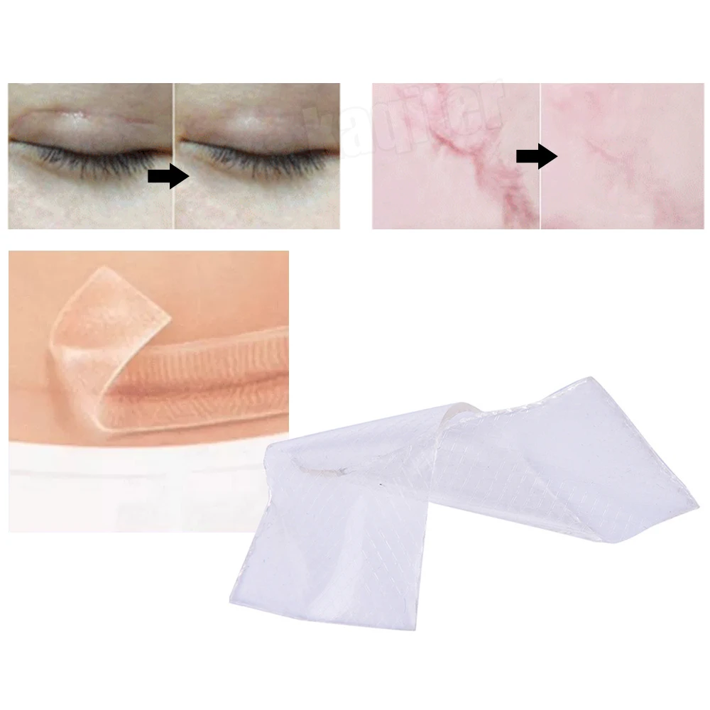 

Lots Silicone Scar Sheets Silicon Gel Patch Scars Caused By Injuries Burns Removal Tape Scar Away 3.5*12cm Self-Adhesive