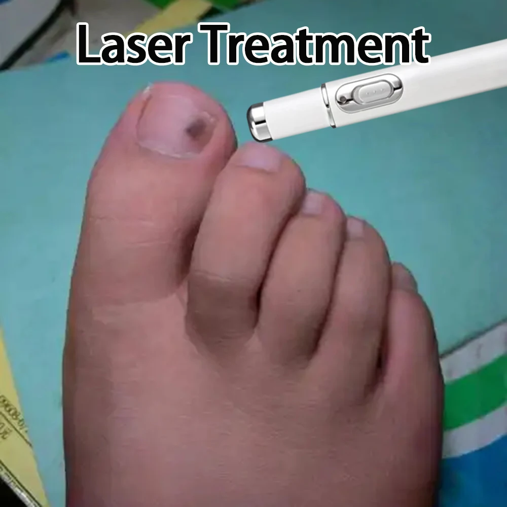 

Устройство для лазерной обработки Устройство для ухода за ногами от онихомикоза для восстановления ногтей на ногах и ногтей, лечение грибка, онихомикоза