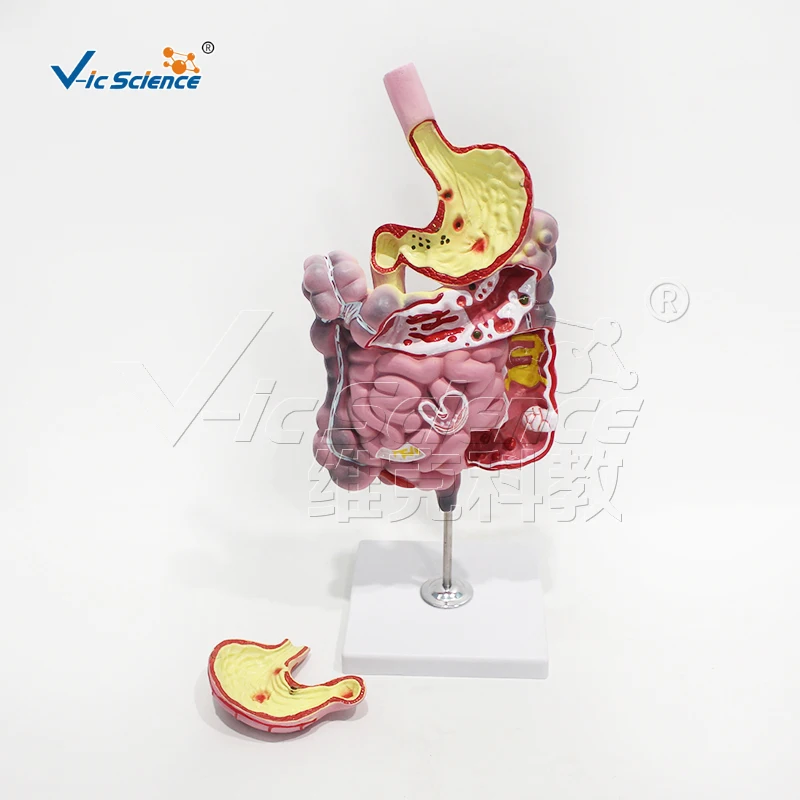 Digestive system lesion anatomy medical science model