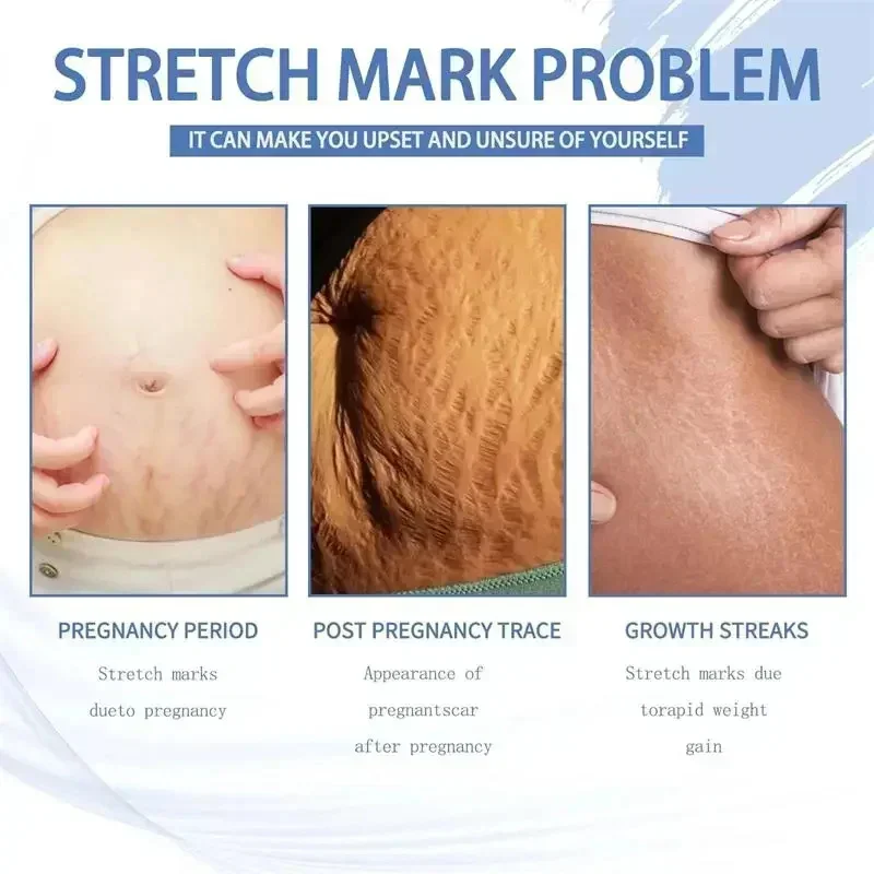 Krim penghilang Stretch mark, krim penghilang permanen menghilangkan Stretch mark perut Tubuh tanda bengkak menghilangkan kulit pecah-pecah Perawatan Pengencang