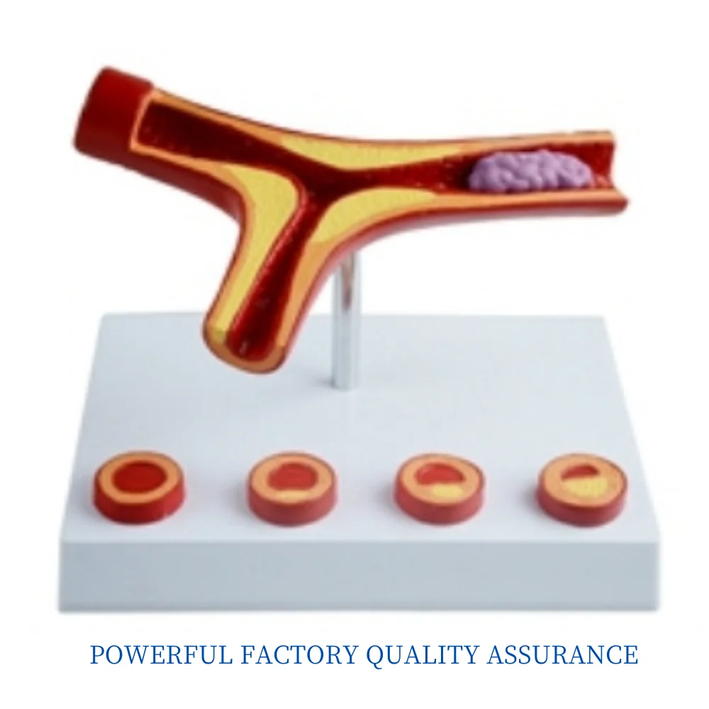 

Arteriosclerosis with thrombosis model 5 parts Medical Science Human Anatomy Simulator Educational Aids Equipment Teaching Tool