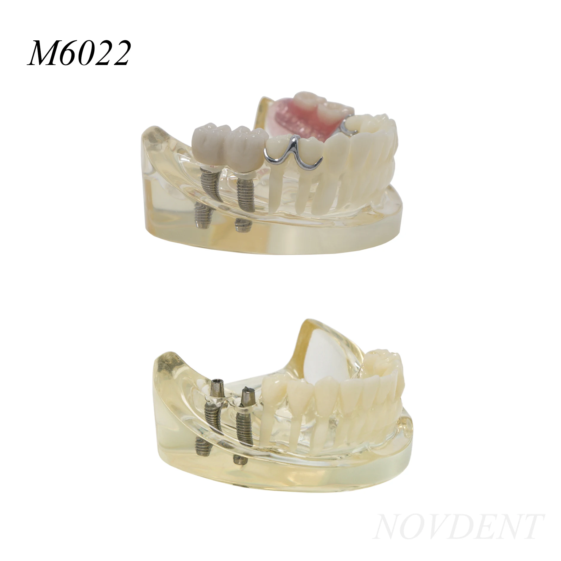 Dental Teeth Model M6022 2 Implants Removable Dental Teaching Research Demonstrations 1 Set