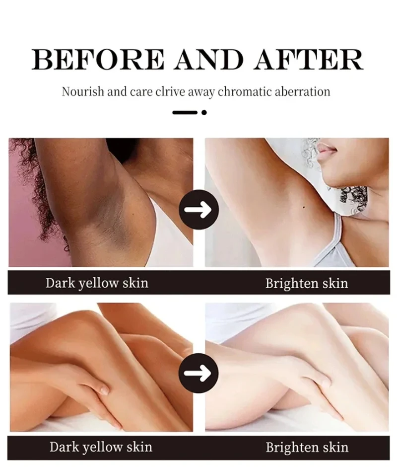 Whitening Cream Private Parts Underarm Bleaching Lotion Whiten Butt Knee Brighten Inner Thigh Intimate Parts Dark Remove Melanin