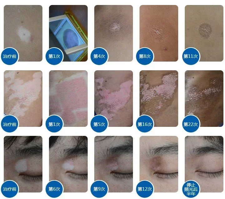 Excimer-LAMpara LASER De Mano Para El Tratamiento Del Vitiligo، Tratamiento Efettivo De La Piel، 308 نانومتر، 308 نانومتر