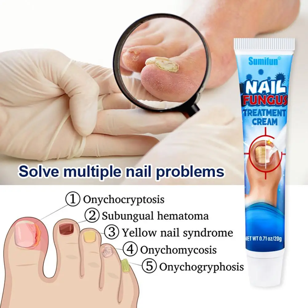 20g Effective Nail Treatments Cream Nail Fungus Removal Cream Toenail Onychomycosis Repair Soft Paronychia Nail Ointment