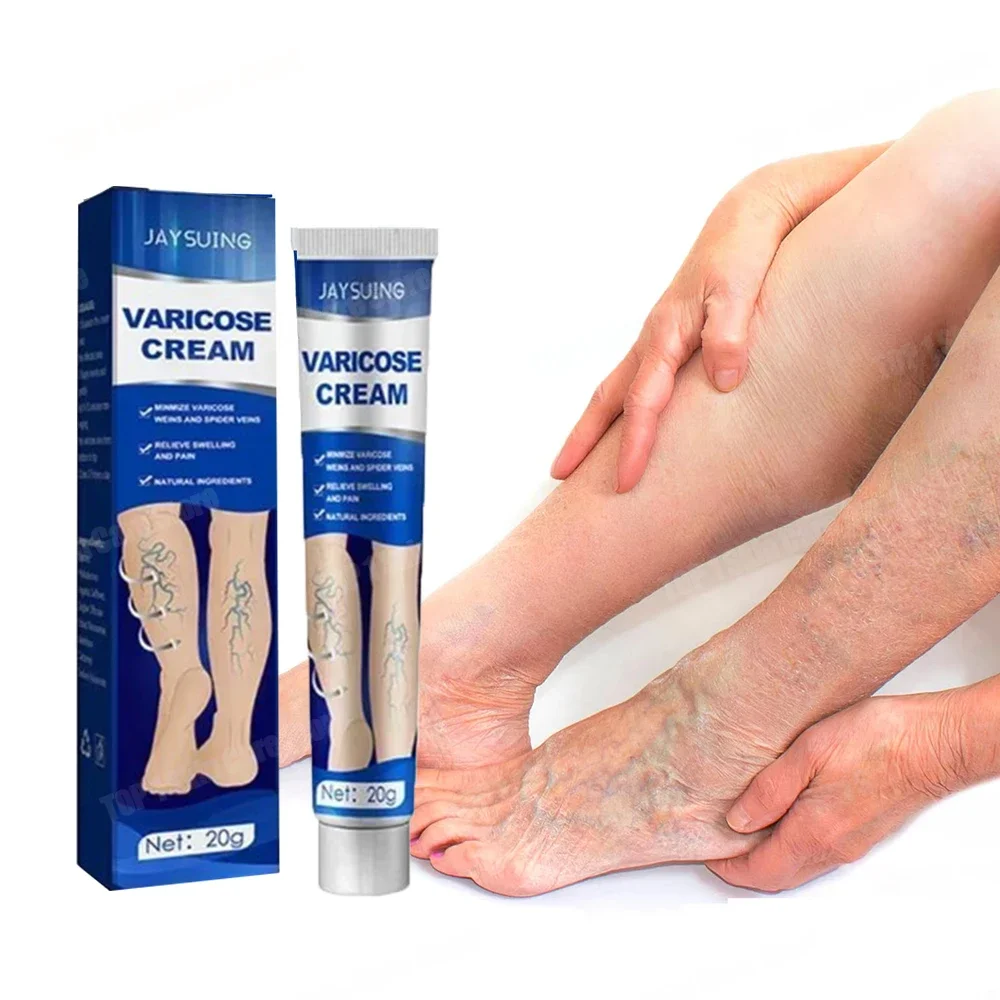 Varicose Vein Ointment, Red Blood Thread Repair, Blue Muscle Uplift Ointment, Nursing Goodbye to Varicose Veins