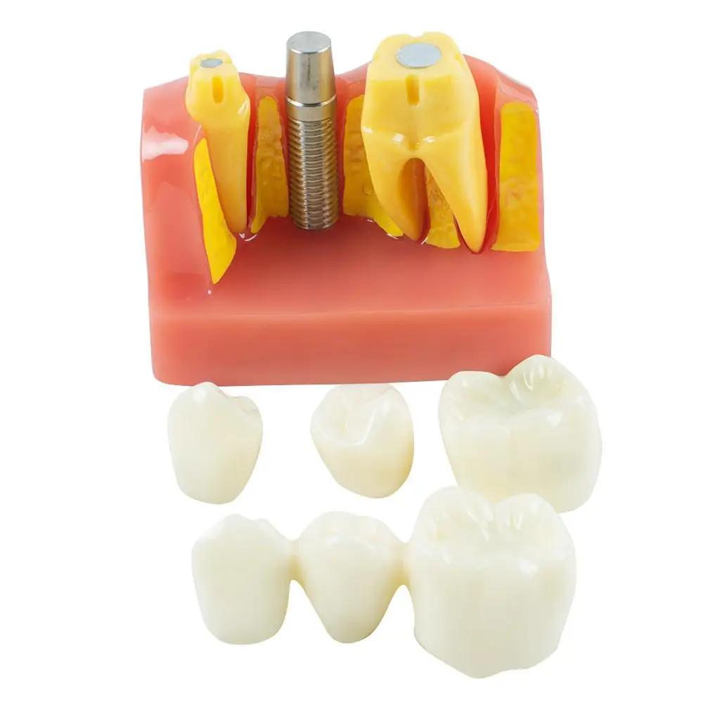 Modèle d'étude dentaire avancé avec modèle de dents parfaites, idéal pour les dentistes, analyse d'implant, démonstration de couronne et de pont