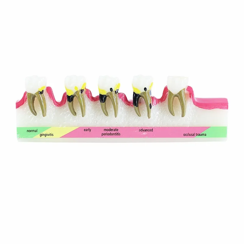 Periodontitis model resin adult periodontal evolution tooth model oral dentistry display teaching ornament