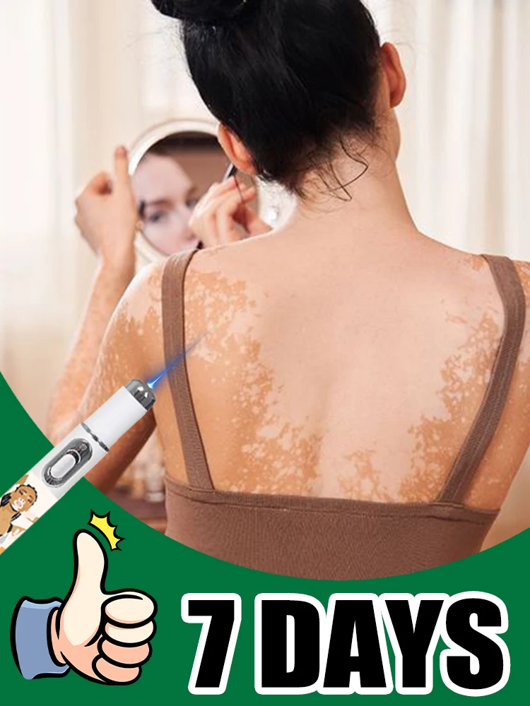 

blue light pen solve Vitiligo,2025 NEW hot sale leg care tools
