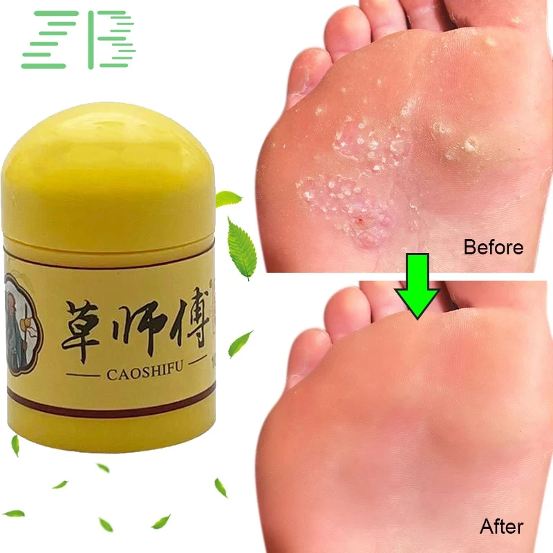 

3pcs Psoriasis Ointment Dermatitis Eczematoid Skin Repair Care Herbs Medical Cream Eczema Antipruritic Antibacterial Dressing