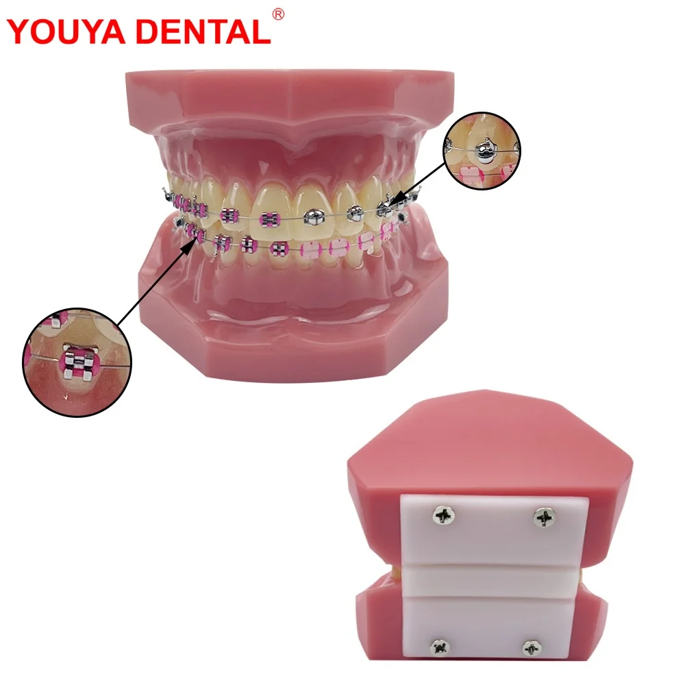 

Orthodontic Model With Brackets 1/4 Spherical Self-Locking Teeth Model Dental Teaching Tooth Model For Dentist-Patient Education