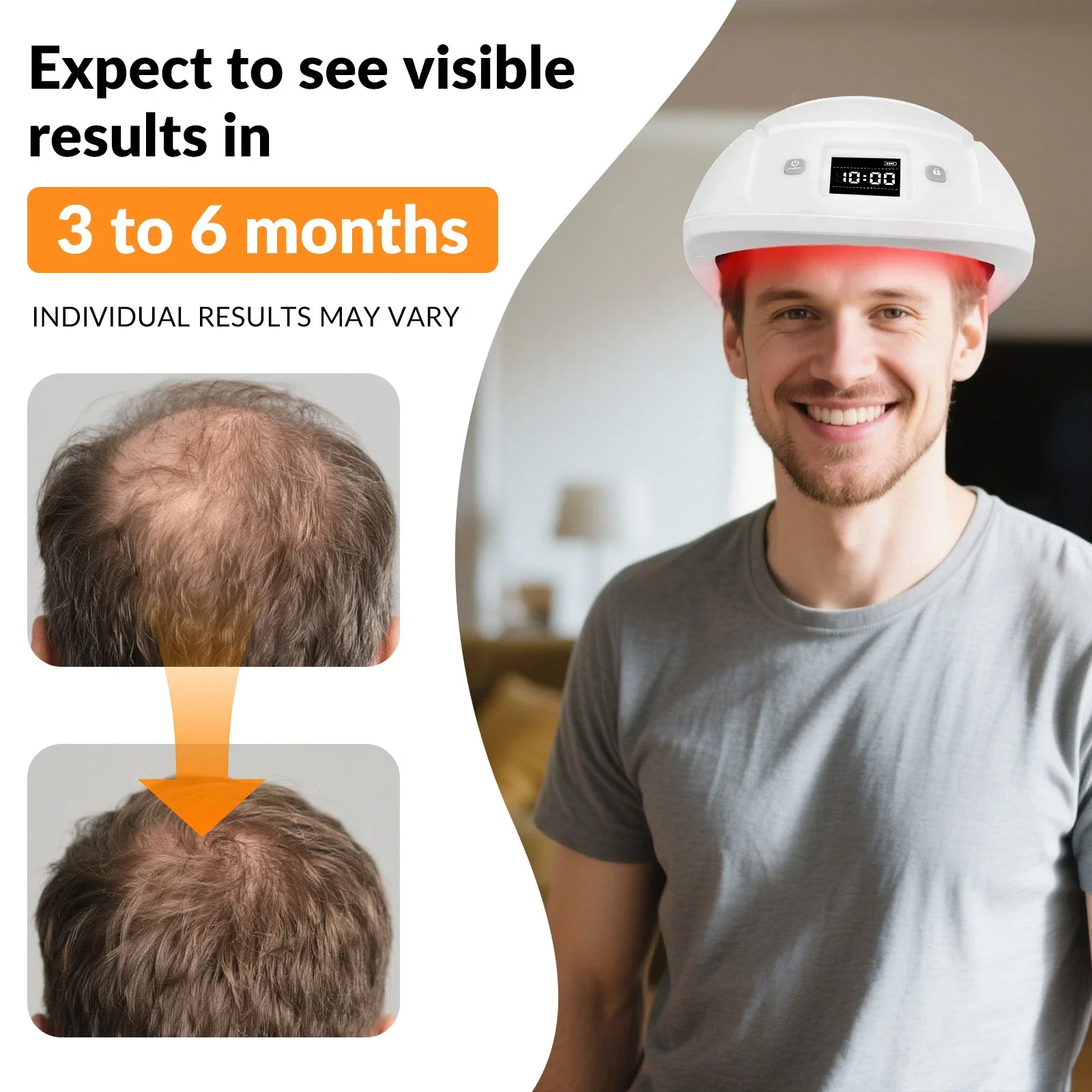 

Усовершенствованный лазерный шлем LLLT для роста волос с 448 диодами, 650 нм, красная светотерапия, против истончения волос, для домашнего использования