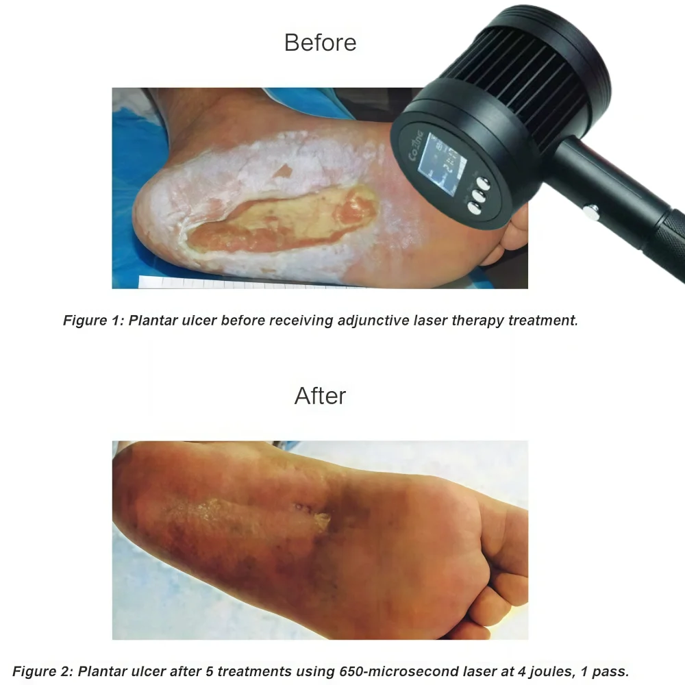 1760mW 650nmx19+808nmx6 Handheld Cold Laser Therapy Device for Pain Relief for Knee Pain Tmj for Human and Pets