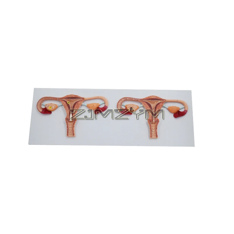 Human Uterus and Ovary Model - 2 Parts- Reproductive Organ Model Life Size Ovary Model Pathological Uterus Anatomical Model