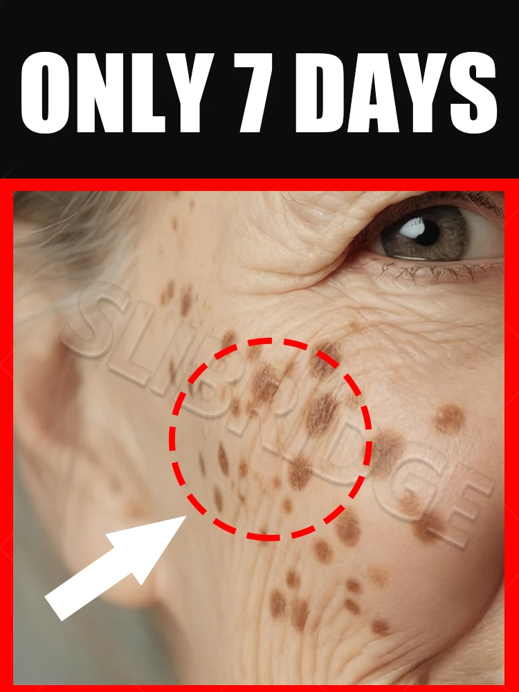2025 Hot Sale Cleaning Melasma Tools Dark New Upgrade Spots Care Tool