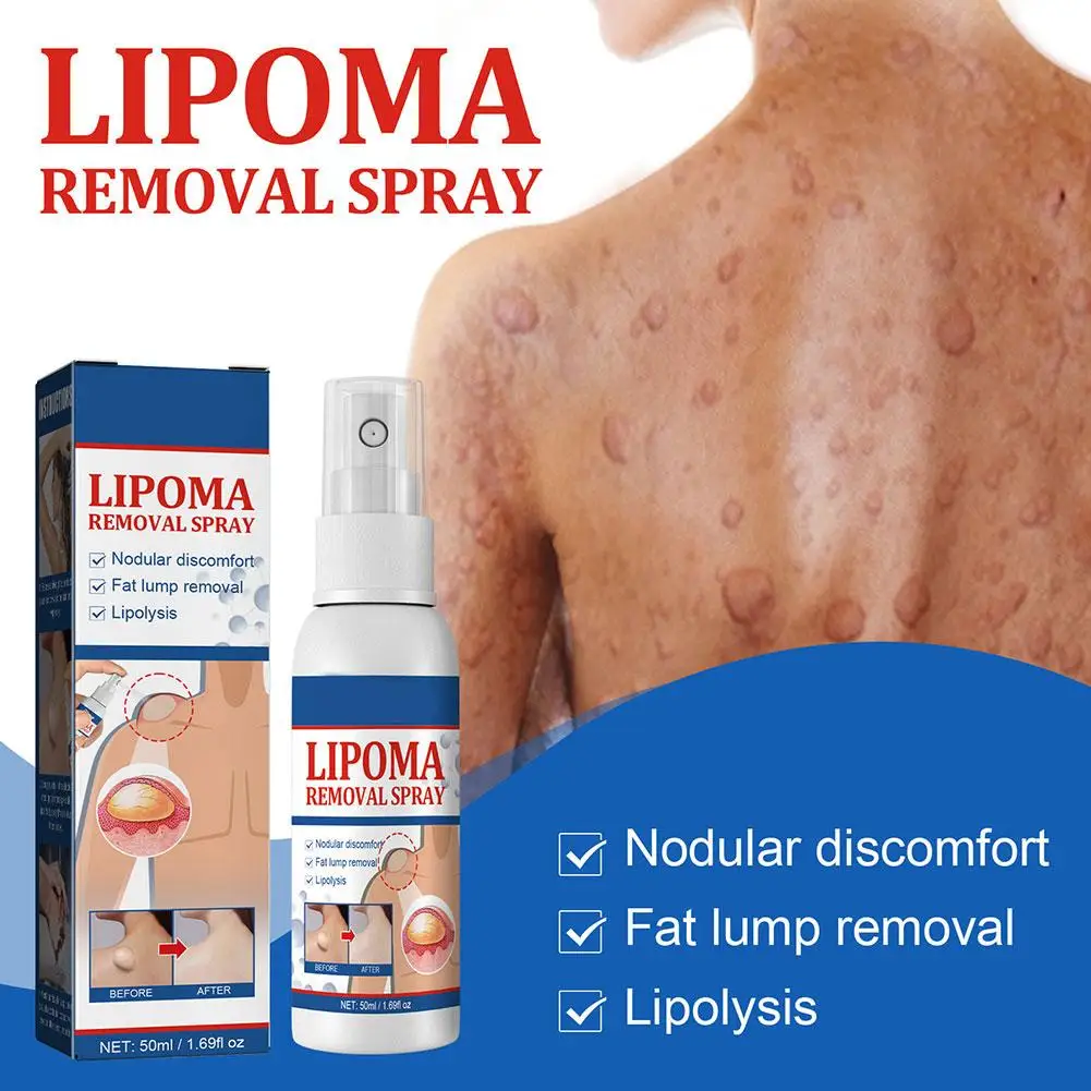 50ml Lipoma Removal Spray Anti tumorale gonfiore della pelle dolore lipolisi trattamento anticellulite Fibroma crema per alleviare i grumi di grasso corporeo