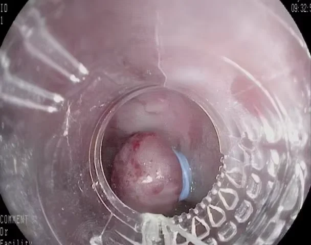 Variceal Ligator for Internal Hemorrhoids Surgery Rubber Band Ligation Hemorrhoids