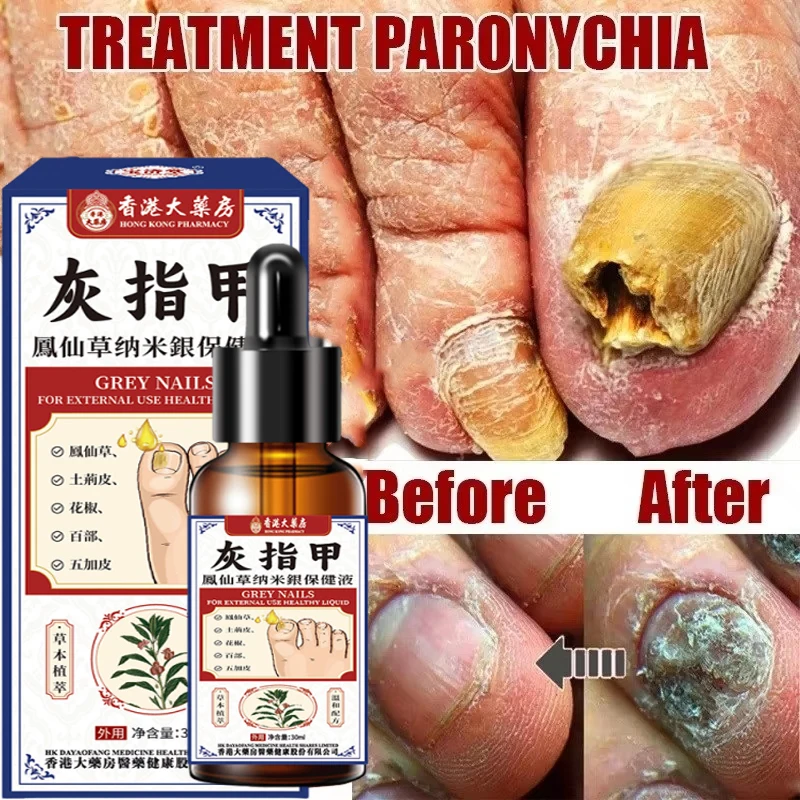 Nail Fungus Treatment Serum Foot Repair Liquid Toe Nails Fungal Removal Gel Anti Infection Paronychia Onychomycosis Cream 30ml