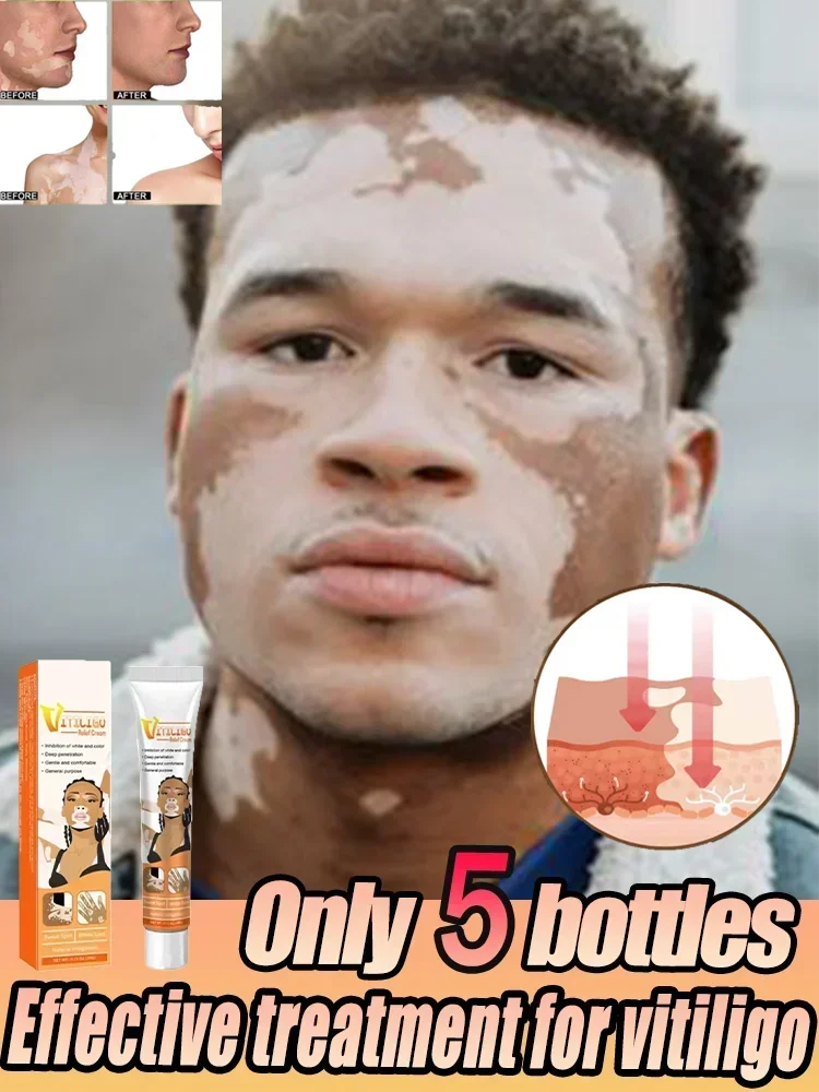 Vitiligo Cream ลบจุดขาวกําจัดผิว Vitiligo กําจัด Vitiligo Body Skin Care ได้อย่างมีประสิทธิภาพ