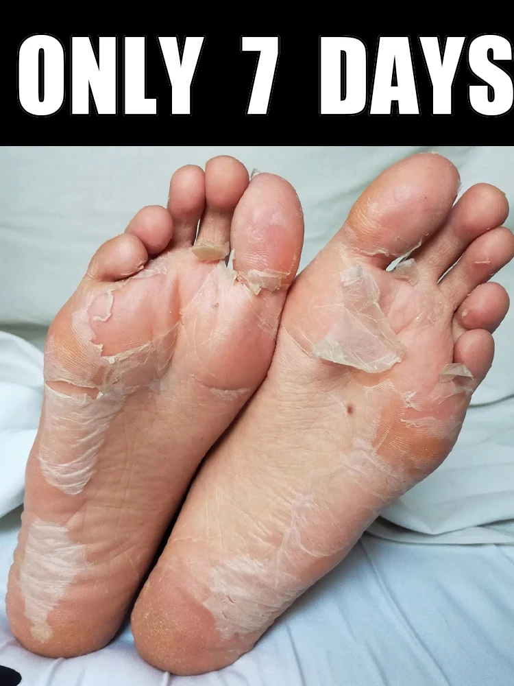 

7-Dᴀʏ Fᴏᴏᴛ Pᴇᴇʟ Mᴀsᴋ ғᴏʀ Dʀʏ, Rᴏᴜɢʜ, Cʀᴀᴄᴋᴇᴅ Fᴇᴇᴛ, Hᴇᴇʟs, ᴀɴᴅ Cᴀʟʟᴜsᴇs