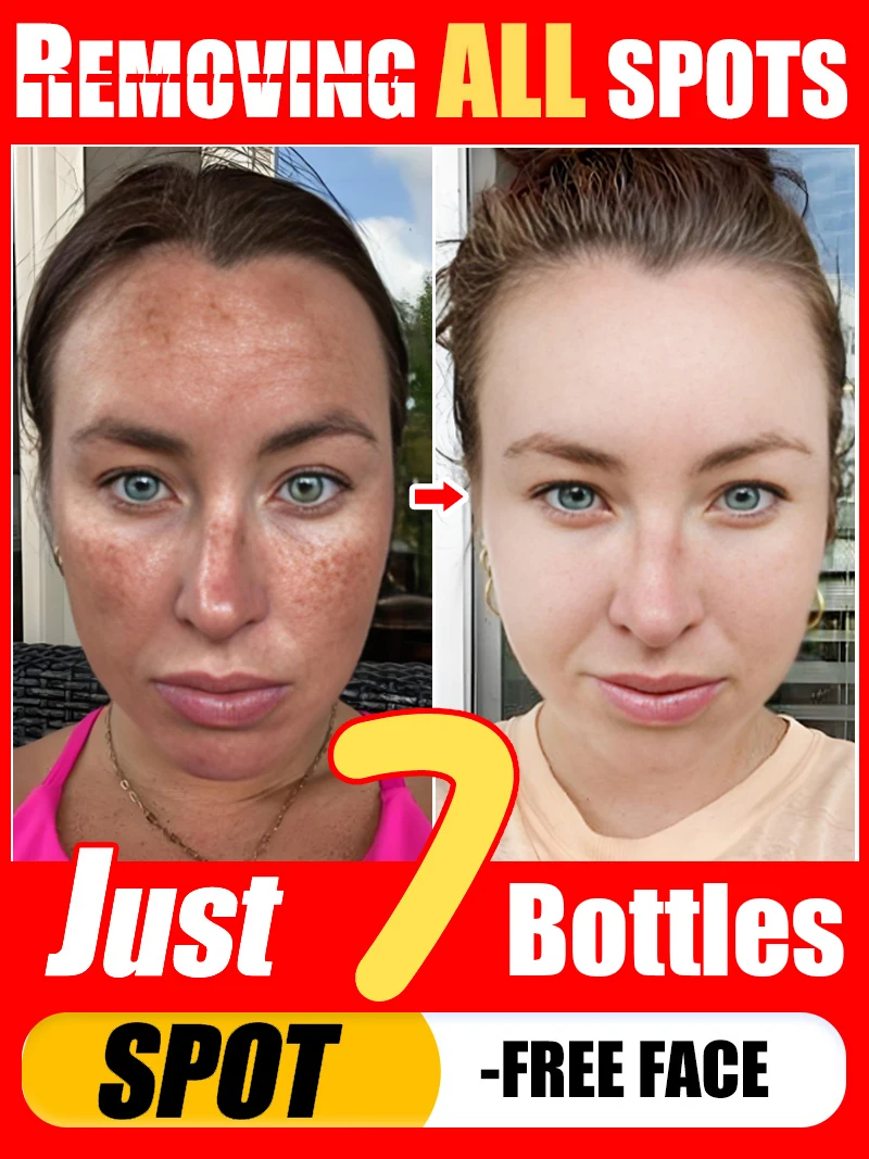 Lightening Facial Freckles Melasma Dark Spots