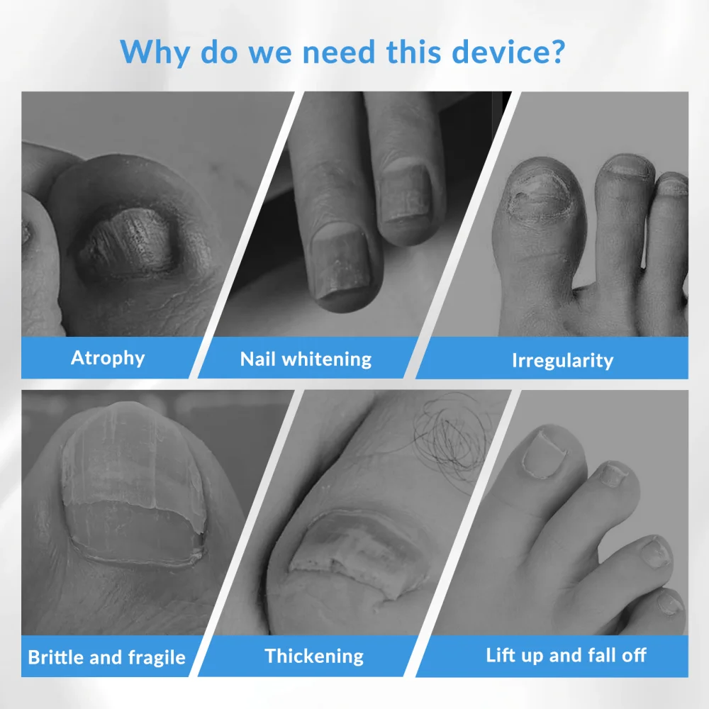 Dawfek Painless Nail Fungus Laser Device Effective Onychomycosis Treatment 660nm 470nm 905nm for Toenails Fungal Nail Repair
