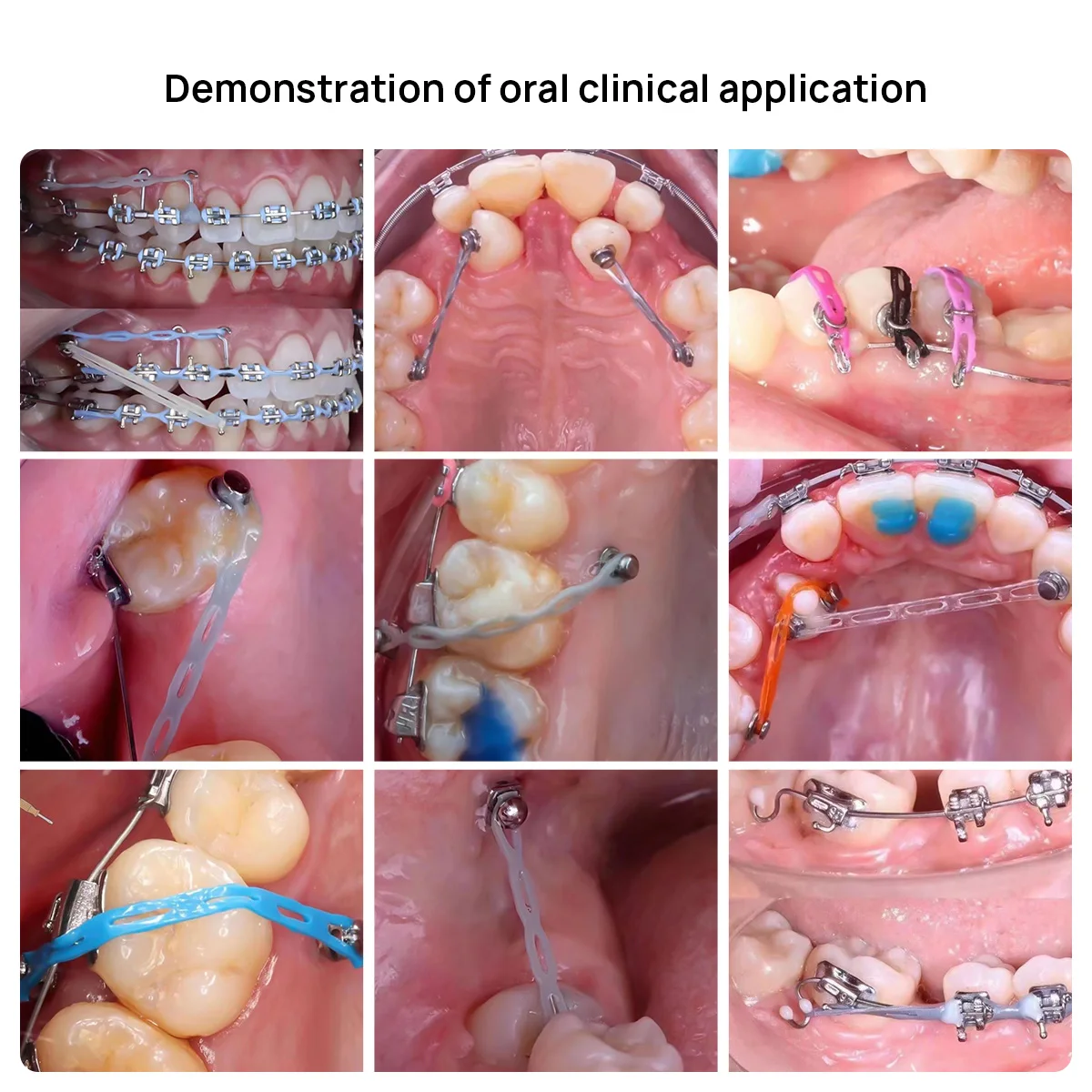 AZDENT-Corrente Elástica Ortodôntica Dentária, Elástico Colorido, 4,57 m = 15 pés Spool, Longa, Curta Alimentação Contínua