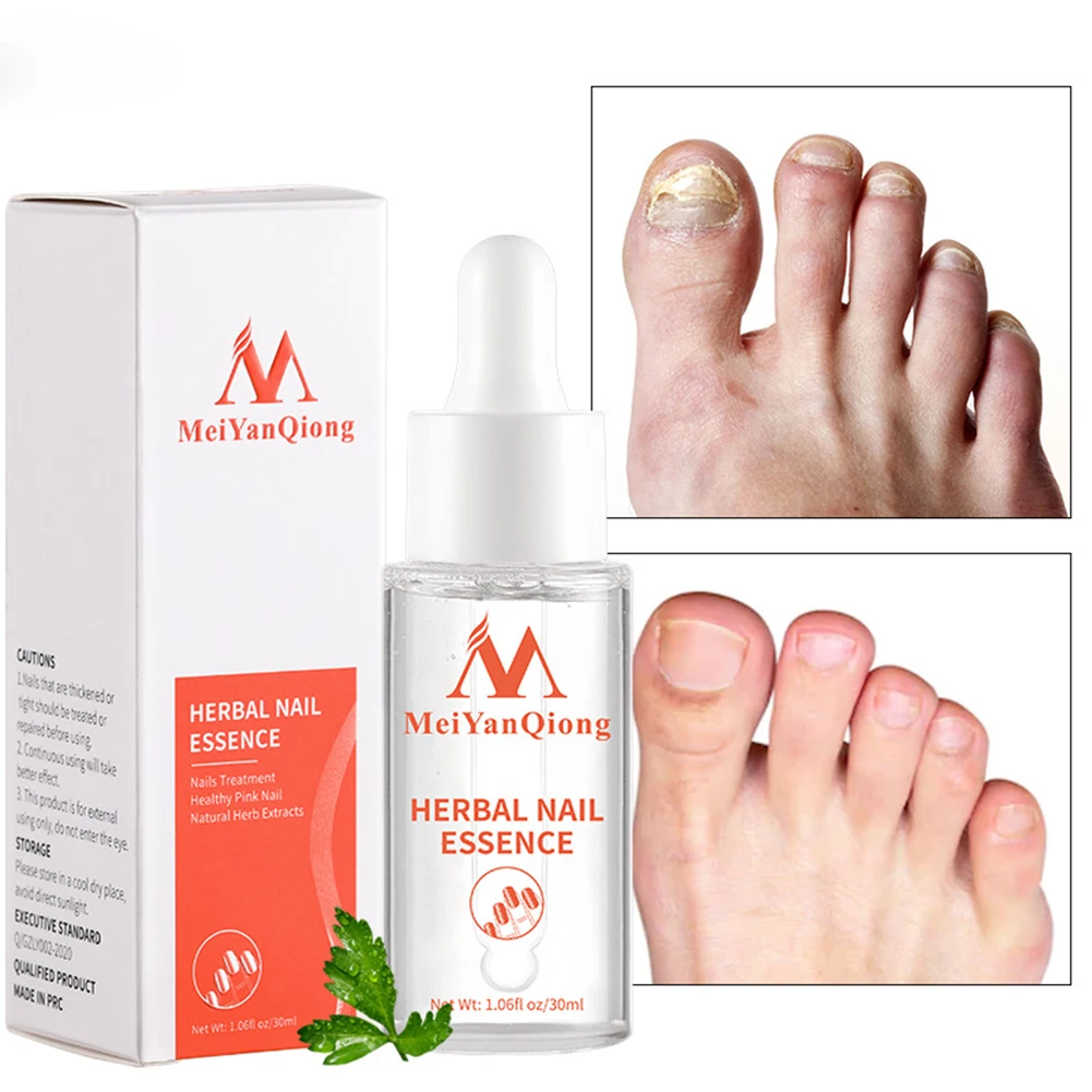 Nail Whitening Serum Anti Infection Nail Whitening Serum Feet Onychomycosis Repair Essence Toe Nourishing Products