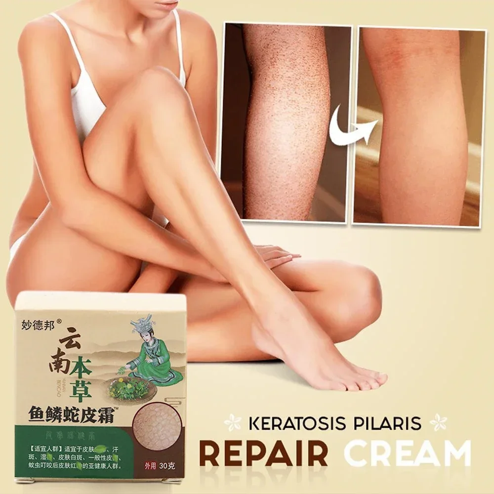 Chicken Skin Repair Cream Curing Keratosis Follicle Pilaris Body Dark Spot Remove Thick Pores Moisturizing Smooth Essence Lotion