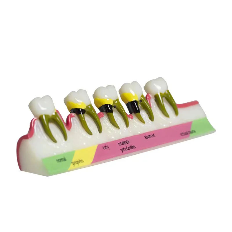 1 PC Dental Periodontitis Model Teeth Disease Caries Model for Dentist Teaching Training Learning Doctor-patient Communication