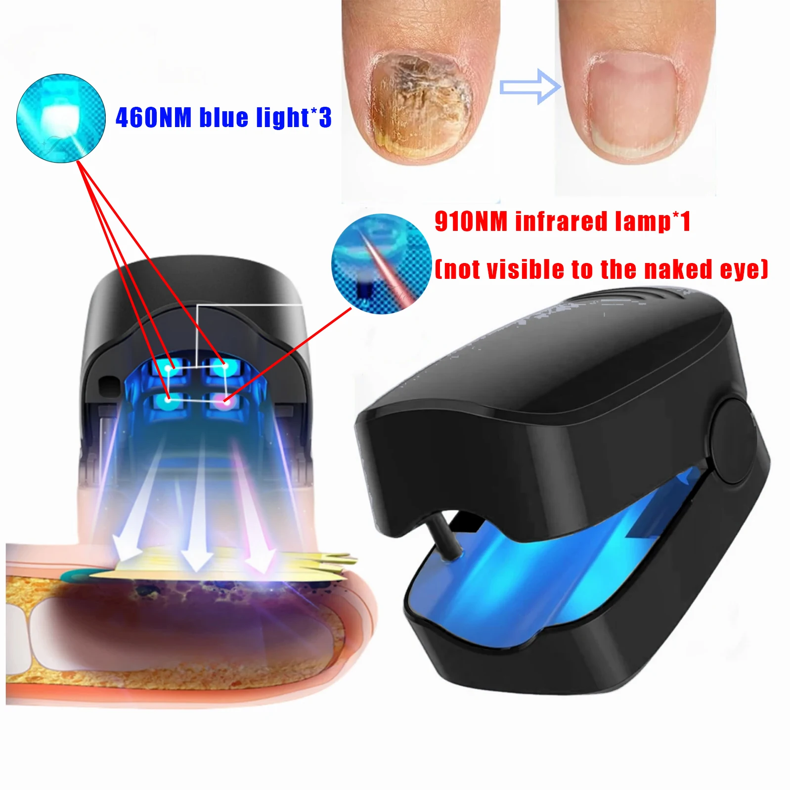 Nail Fungus Treatment LED Laser Device for Cleaning Onychomycosis USB Charge 905nm Infrared Light 470nm Blue Light Nail Salon