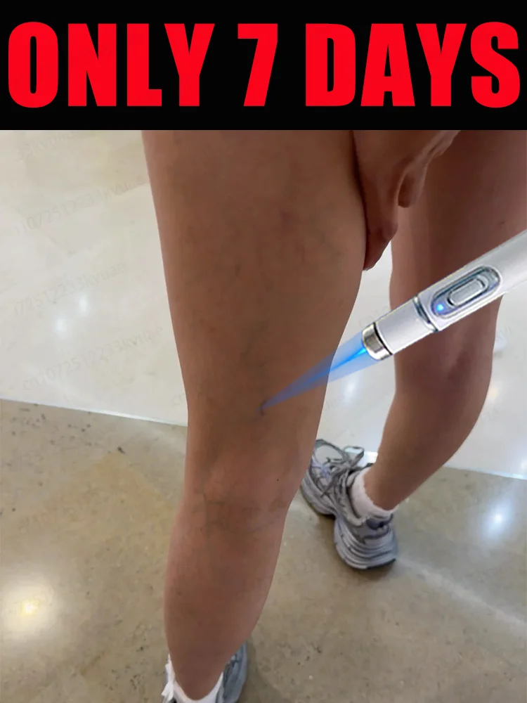 Thérapie au Laser à lumière bleue, stylo pour varices, phlébite, vascularite, Circulation sanguine, haute qualité, Anti-gonflement, renflement des vaisseaux sanguins