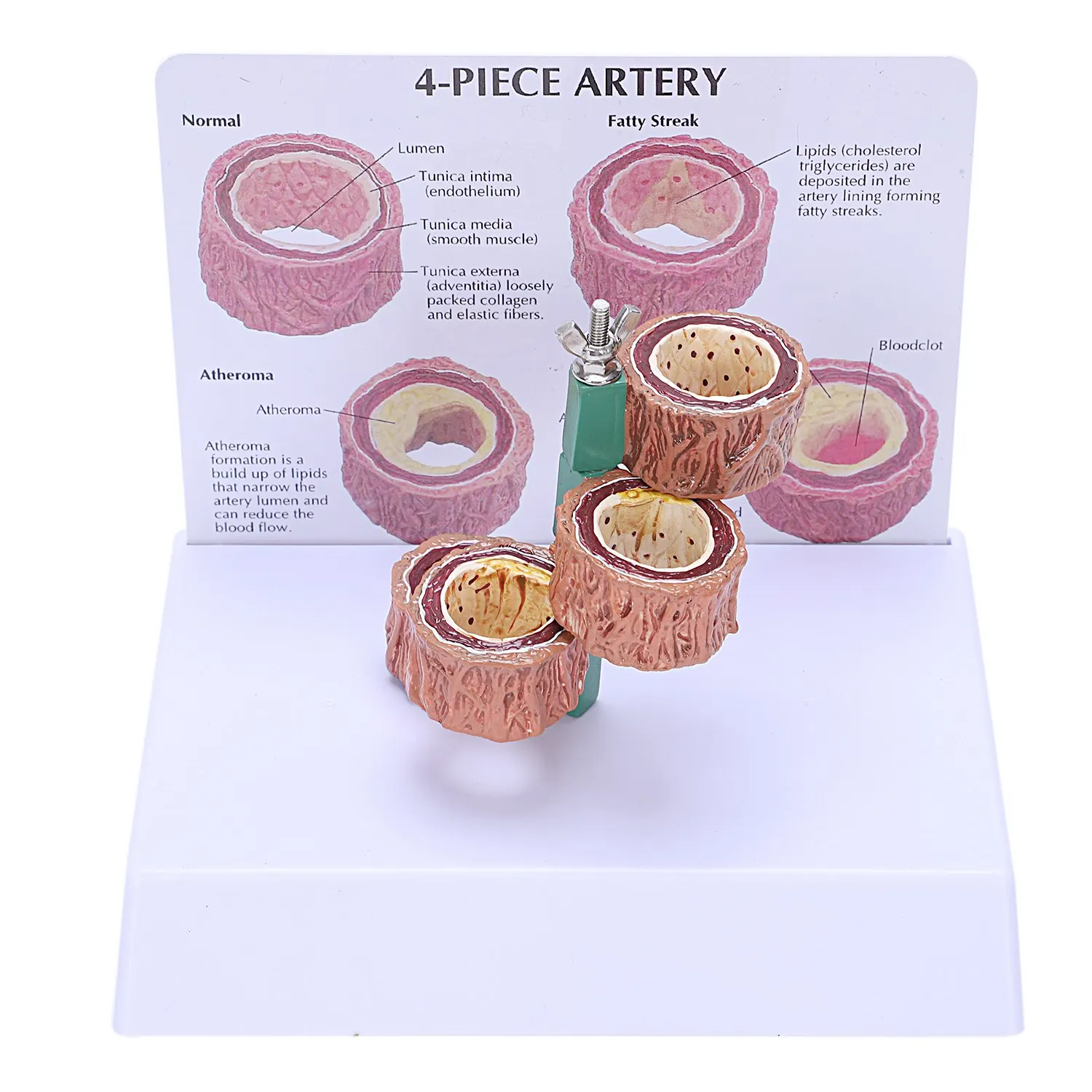 Atherosclerosis Thrombosis Model Vascular Disease Demonstration Heart Vascular Pathology Model