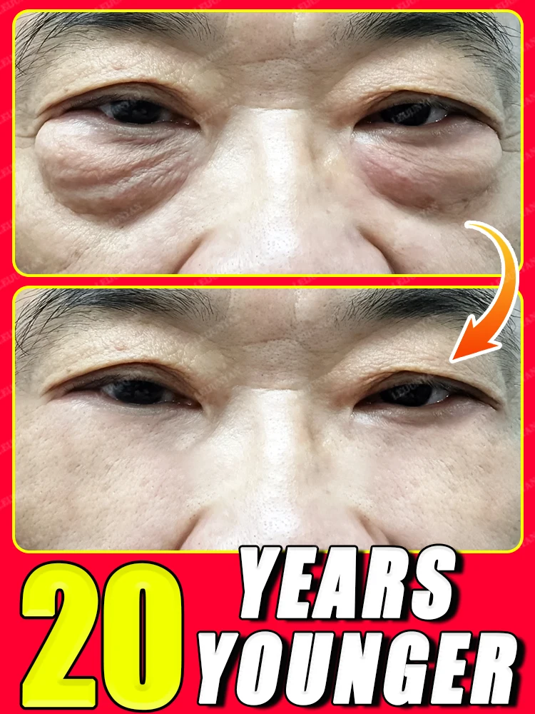 

ᴱˡⁱᵐⁱⁿᵃᵗᵉ eye bags and dark circles to keep your eyes young