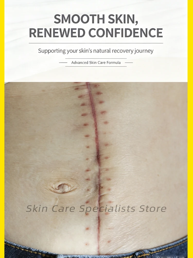 Herbal Scar Care Cream for You 30g