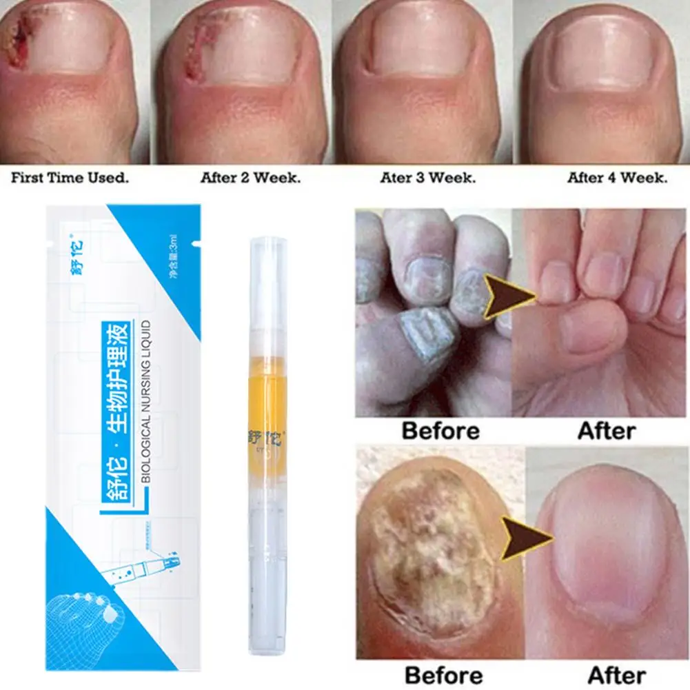 1PCS Nail Fungus Treatment Essence Serum Care Nail Nail Liquid Care Removal Care Health Products Repair Strong And Protecti D2E2