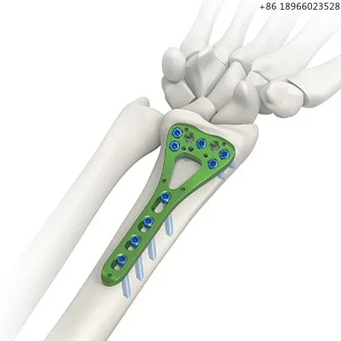 JINLU MEDICAL Bone - related surgical Insert multi-axial distal radius locking plate for left or right