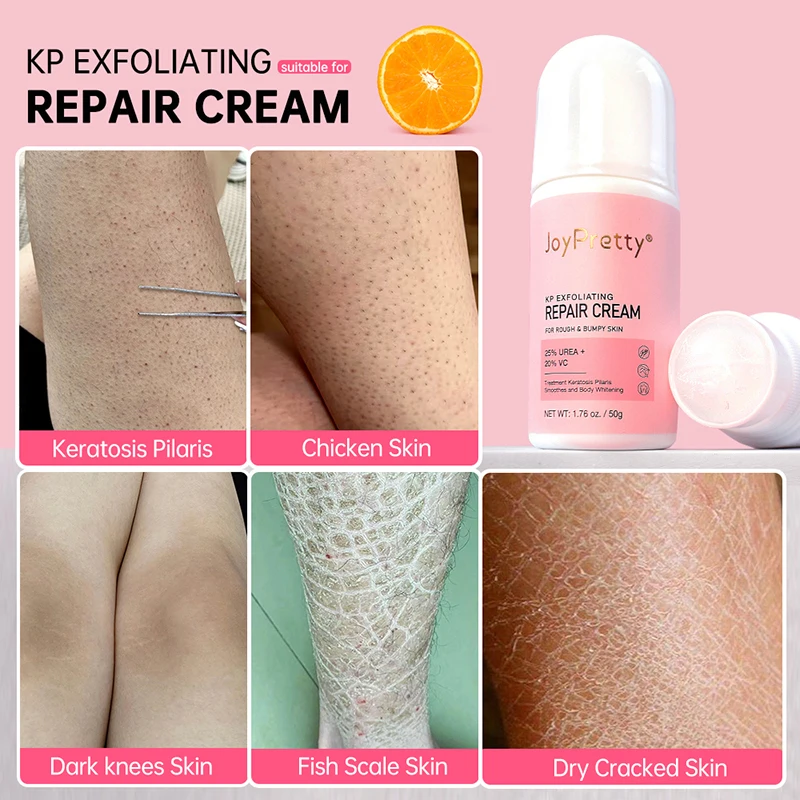 Krim Tubuh perawatan penghilang kulit ayam Losion Keratosis Pilaris krim pemutih pelembap perawatan Noda pori kasar 60g