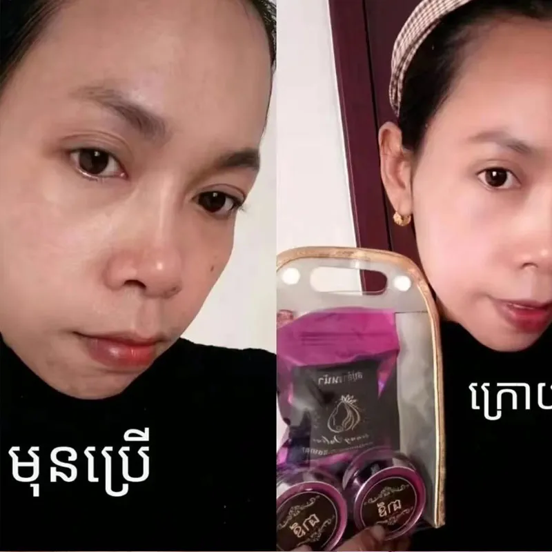 Thailand Whitening Spot Removing Set, Acne Removing, Anti aging, Moisturizing, Bright White, Smoothing, Deep Repair