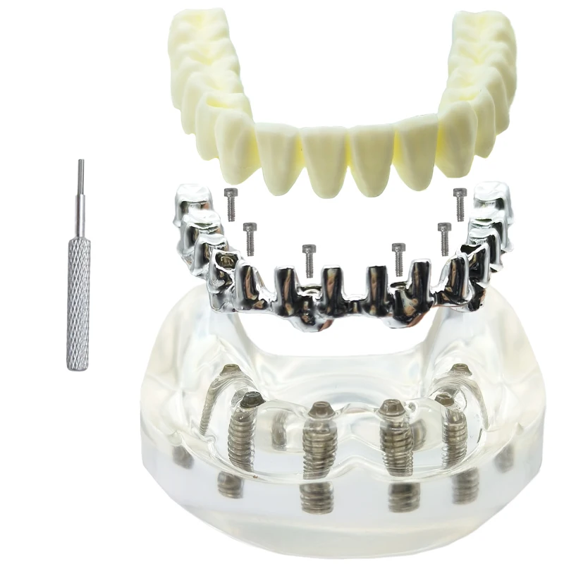 Zahnimplantatmodell, transparenter oberer unterer Kiefer, 6 Implantate, Overkappungszähne, Wiederherstellungszähne mit 6 abnehmbaren Schrauben, Dental Demo – Detail 6
